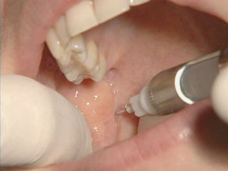 gây tê trong điều trị tủy răng