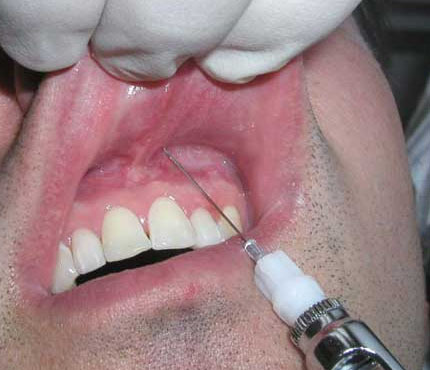gây tê trong điều trị tủy răng