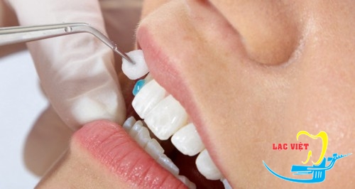 Bọc sứ là phương pháp chỉnh răng hô nhanh chóng