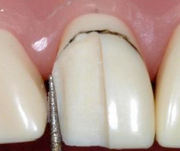 kỹ thuật mài cùi răng cho răng sứ không kim loại