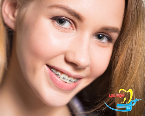 Niềng răng là phương pháp chỉnh răng hô được ưa chuộng nhất